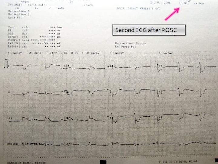 ECG at 3:09 pm, shortly after Sherry prayed for him, and his heartbeat returned.