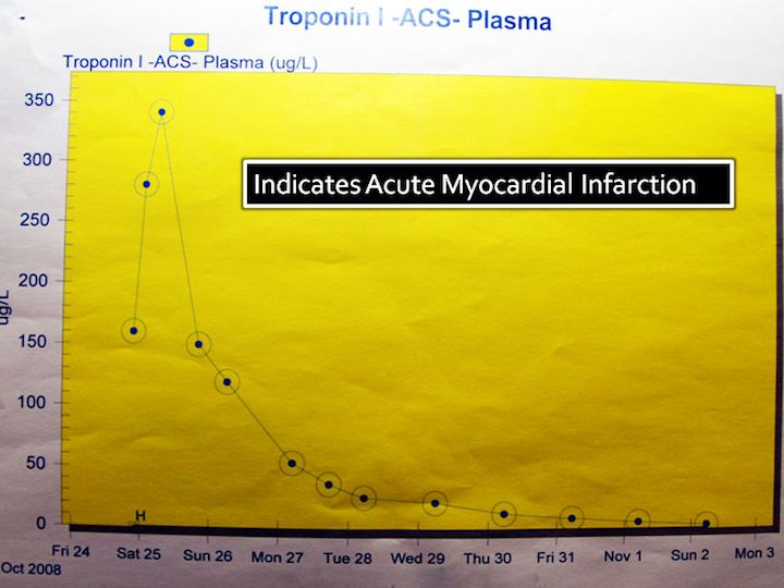 Indication of acute myocardial infarction (= heart attack) during 25th October.